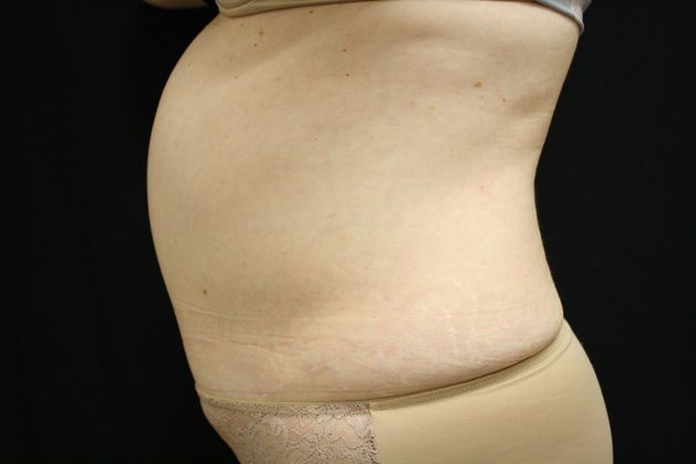 CoolSculpting: Case 4 - Before