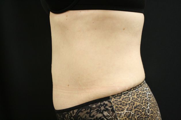 CoolSculpting: Case 4 - After 2 treatments
