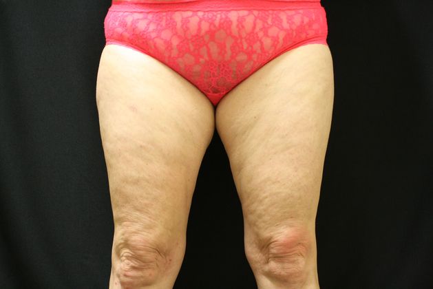 CoolSculpting Case 5 - Before