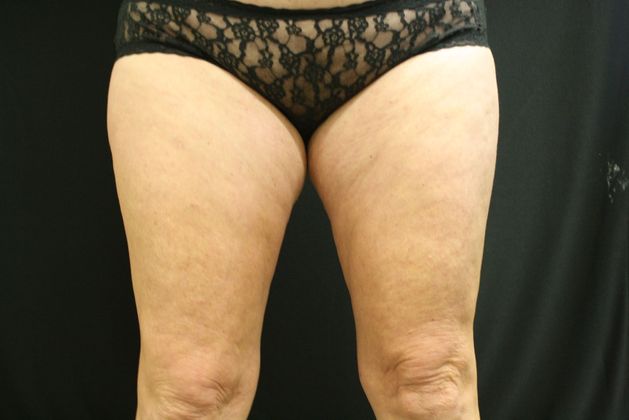 CoolSculpting Case 5 - After