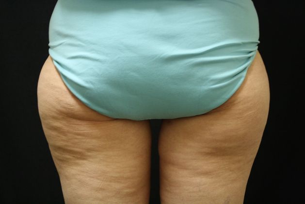 CoolSculpting Case 6 - Before