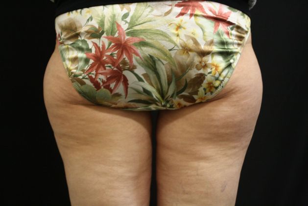 CoolSculpting Case 6 - After