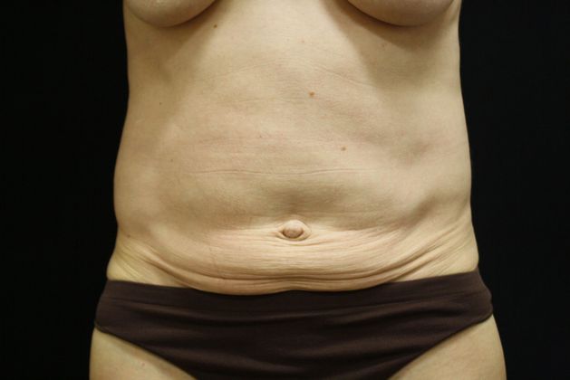 Tummy Tuck: Case 10 - Before