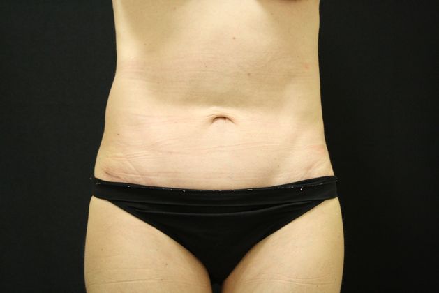 Tummy Tuck: Case 10 - After