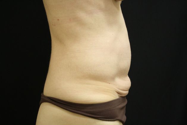 Tummy Tuck: Case 10 - Before