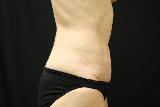 Tummy Tuck: Case 10 - After