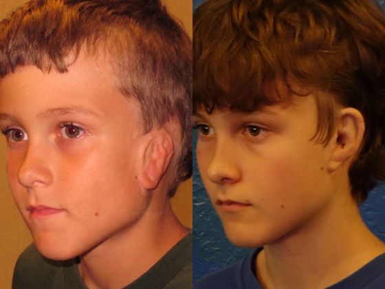 Correcting Prior Surgeries: Example 5 - 9 yr. old with prior cartilage surgeries, after single Medpor revision.