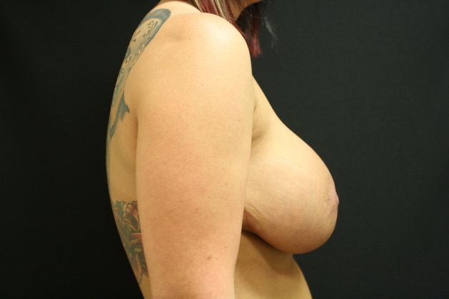 Breast Augmentation Exchange/Revision: Case 5 - Before