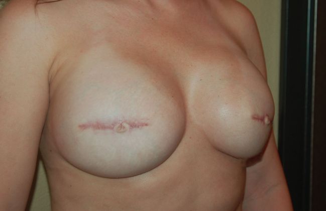 Breast Reconstruction: Case 39 - After