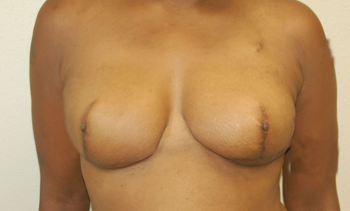 Breast Reconstruction Case 40 - After