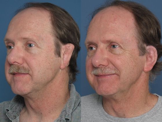 53 year old 2 years after revision of prior cartilage reconstruction.