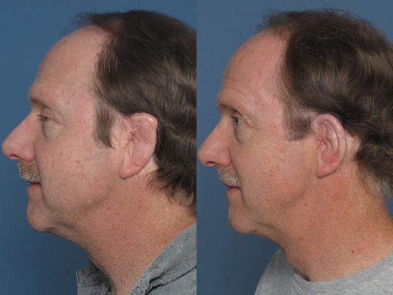 Two years following single outpatient surgical Medpor revision.