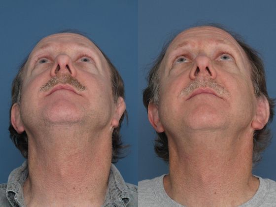 Before & After - Correcting Prior Surgeries - Before and After Gallery