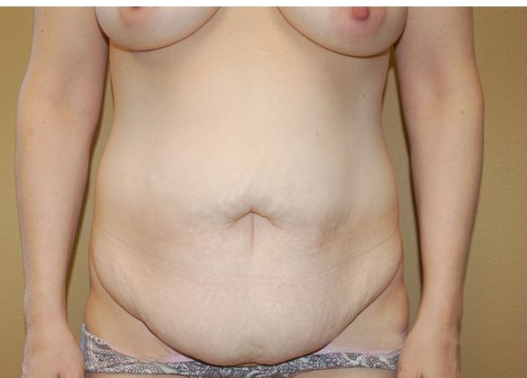 Massive Weight Loss : Case 18 - Before