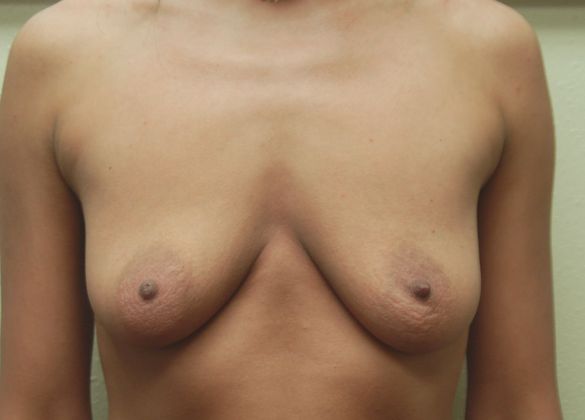 Breast Augmentation w/ Lift: Case 87 - Before