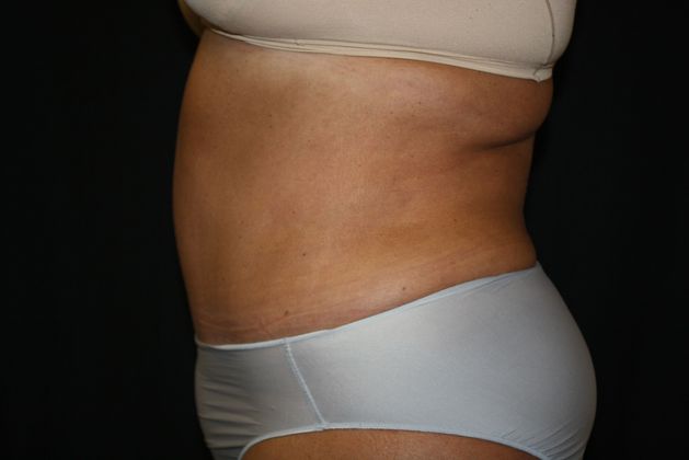 Tummy Tuck: Case 5 - After