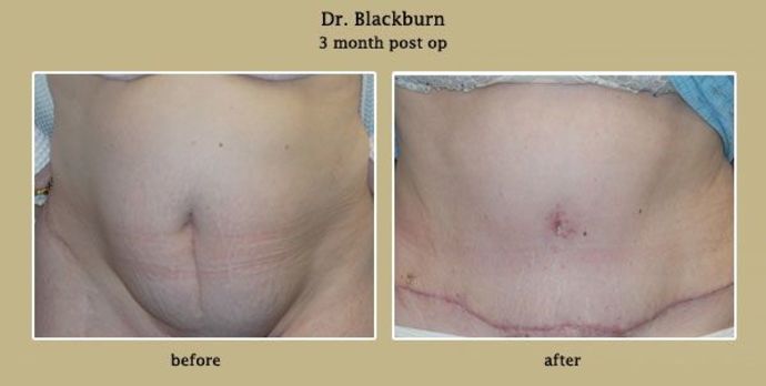 Abdominoplasty Patient 1
