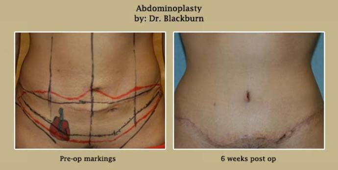 Abdominoplasty Patient 2