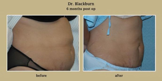 Liposuction Patient 1