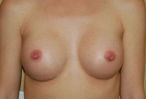 Breast Augmentation Case 211 - After