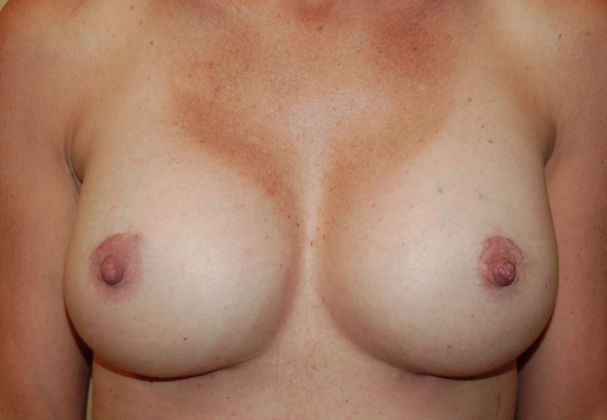 Breast Augmentation w/ Lift Case 88 - After