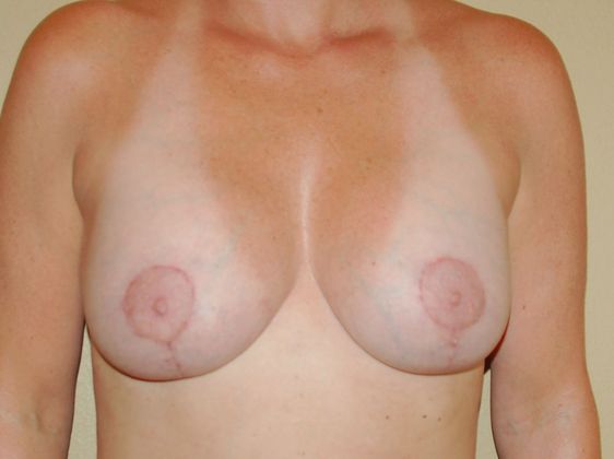 Breast Augmentation w/ Lift Case 89 - After