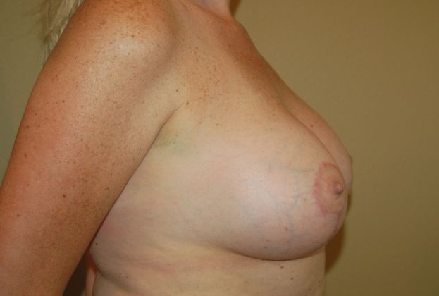Breast Augmentation w/ Lift: Case 90 - After