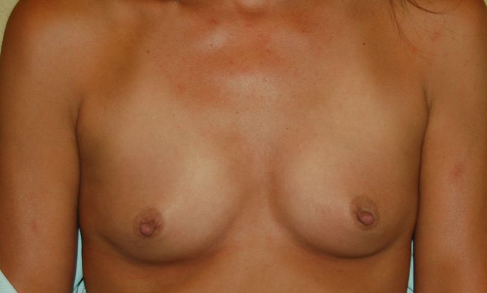 Breast Augmentation Case 213 - Before