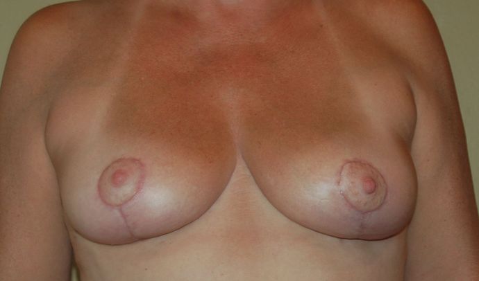 Breast Lift (Mastopexy) Case 15 - After