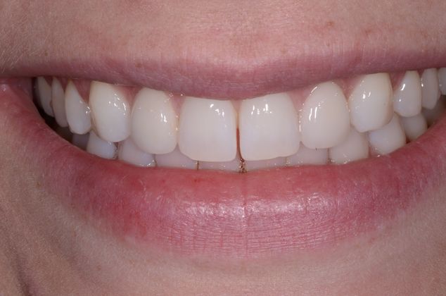 Porcelain Veneers Case 6 - After