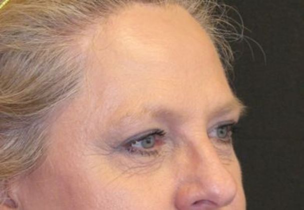 blepharoplasty (eyelid lift): Case 5 - After 4 years