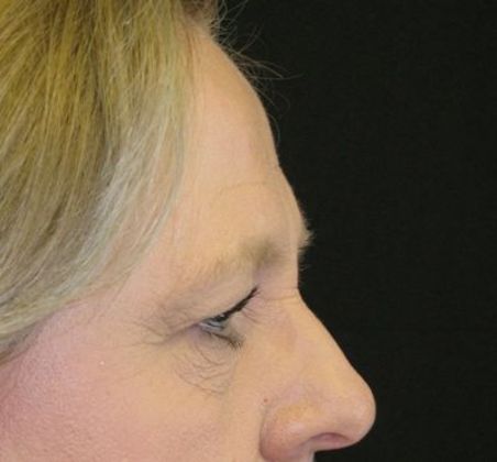 blepharoplasty (eyelid lift): Case 5 - Before