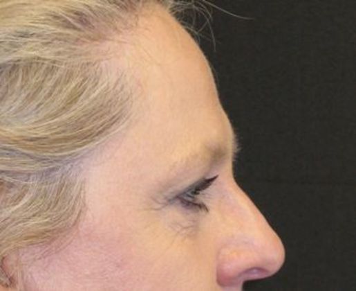 blepharoplasty (eyelid lift): Case 5 - After 4 years