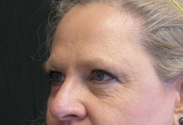 blepharoplasty (eyelid lift): Case 5 - After 4 years