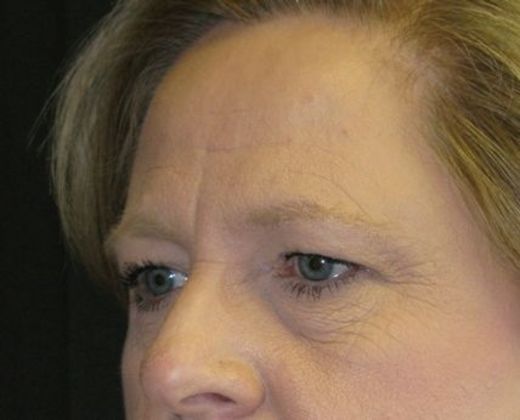 Brow lift: Case 3 - Before