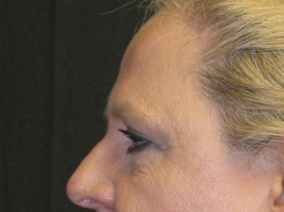 Brow lift: Case 3 - After 4 years