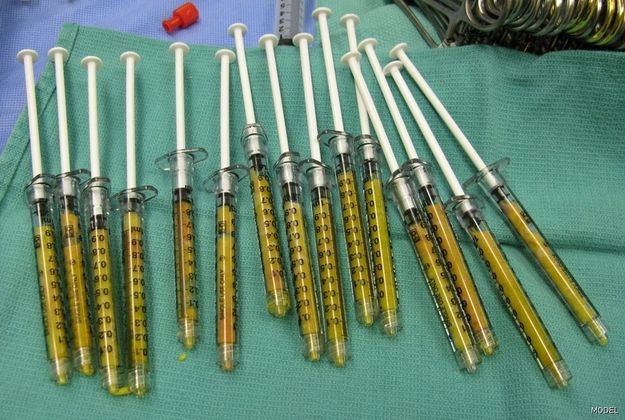 Fat Grafting Case