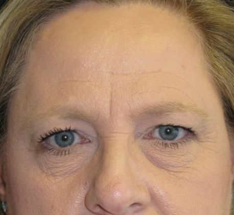 Fat Grafting: Case 1 - Before