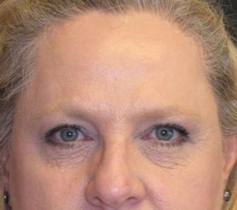 Fat Grafting: Case 1 - After 4 years