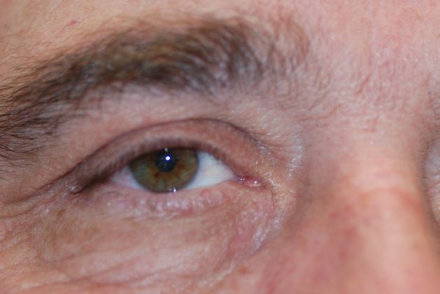 Facial Tumors and Growths Case 12 - After