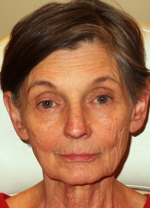 Botox® Cosmetic, Dysport, Xeomin Injectables: Case 9