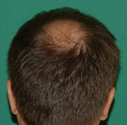 3000 Graft Crown Restoration - Hair Loss Surgery - Before and After Gallery