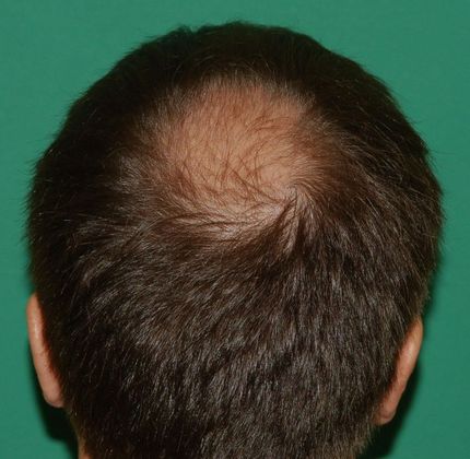 3000 Graft Crown Restoration - Hair Loss Surgery - Before and After Gallery