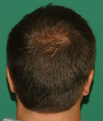crown loss hair graft restoration surgery postop