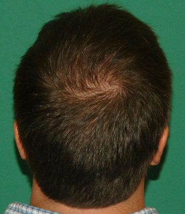3000 Graft Crown Restoration - Hair Loss Surgery - Before and After Gallery
