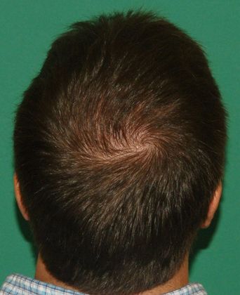 Hair Loss Surgery: 3000 Graft Crown Restoration - Postop View 3