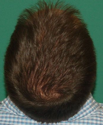 3000 Graft Crown Restoration - Hair Loss Surgery - Before and After Gallery