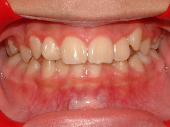 Orthodontics: Case 2 - Before