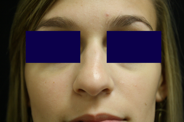 Rhinoplasty: Case 1 - Before