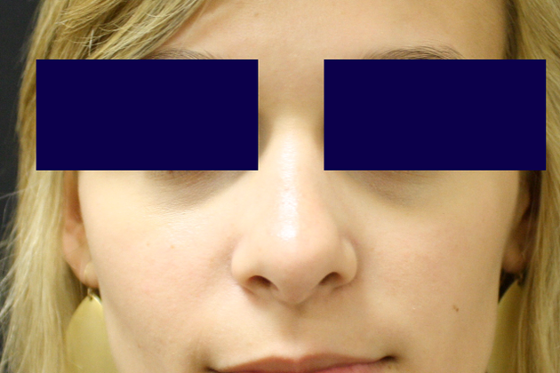 Rhinoplasty: Case 1 - After